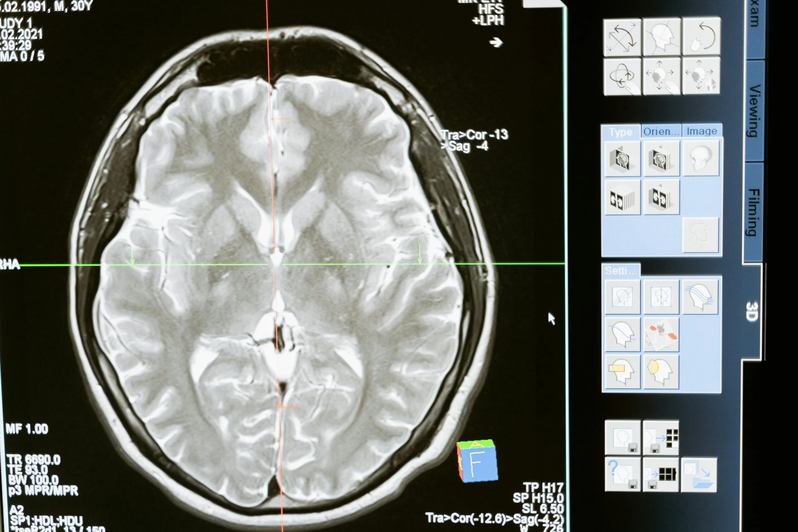 Brain MRI scan on a computer screen representing the neuroscience behind pornography addiction and relapse